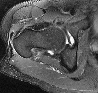 Figure 3 for case Gluteus minimus calcific tendinitis